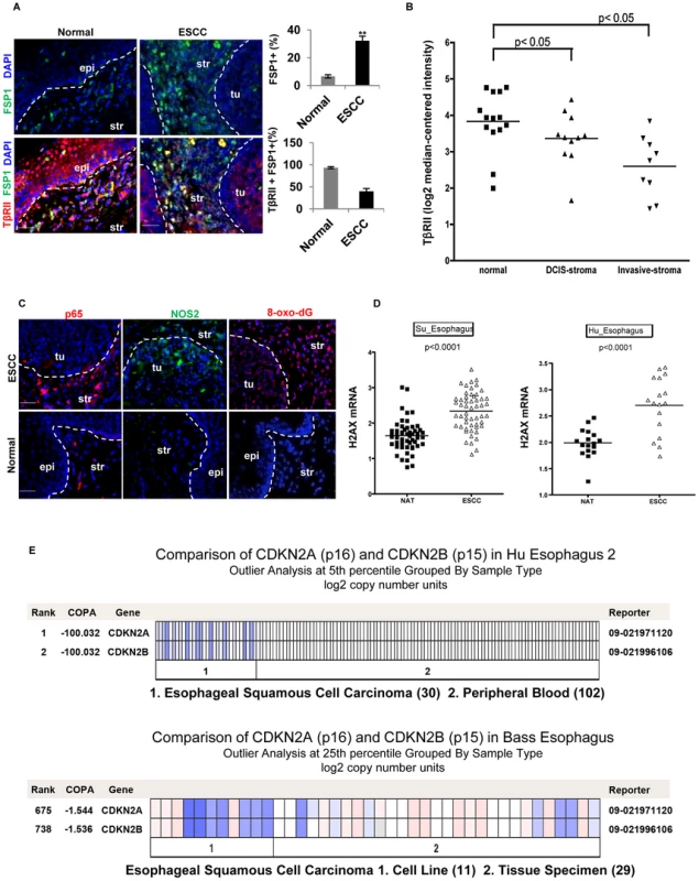 Reduced expression of TβRII in FSP1+ stromal cells, evident inflammation and DNA damage in human ESCC.