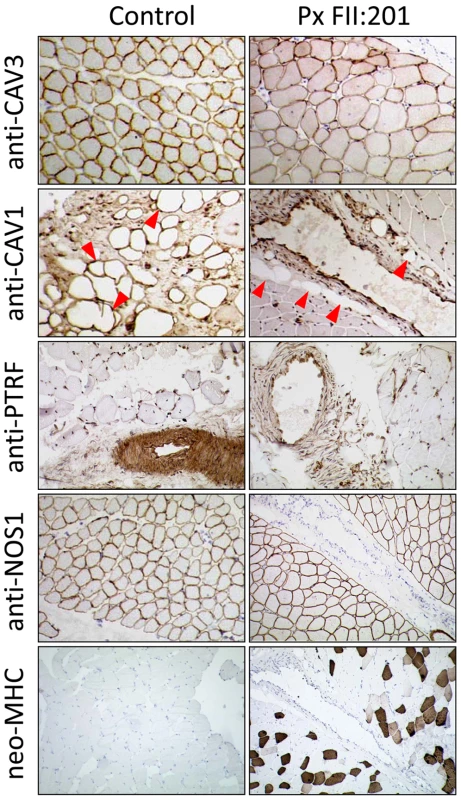 Immunohistochemistry of a muscle biopsy specimen from patient FII:201.