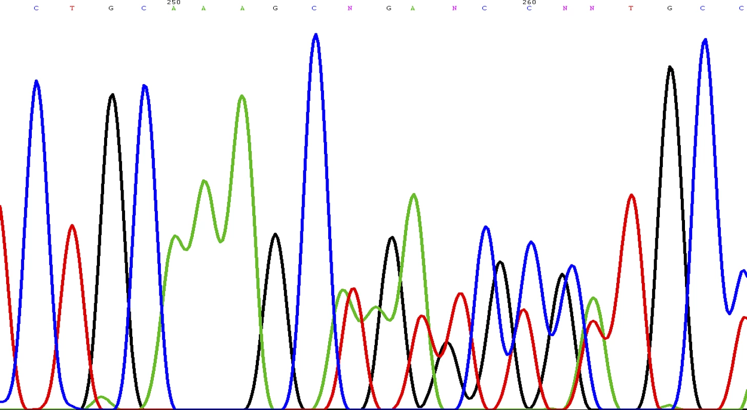 Sequence Chromatogram Showing the Novel Frameshift Mutation of the &lt;i&gt;SDHD&lt;/i&gt; Gene: c.449_453dup (p.Val153LysfsX17)