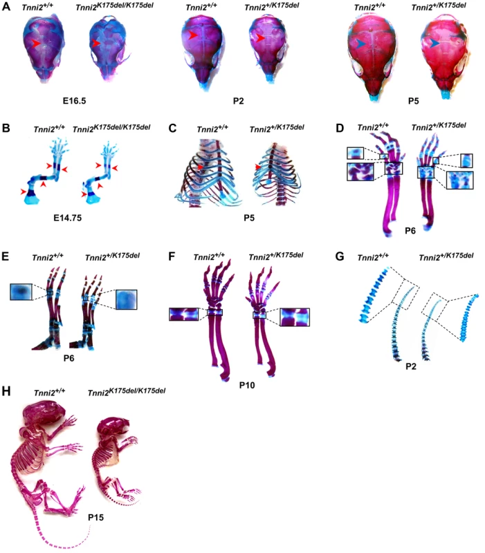 The <i>Tnni2<sup>K175del</sup></i> mutation disturbed bone development of mice.