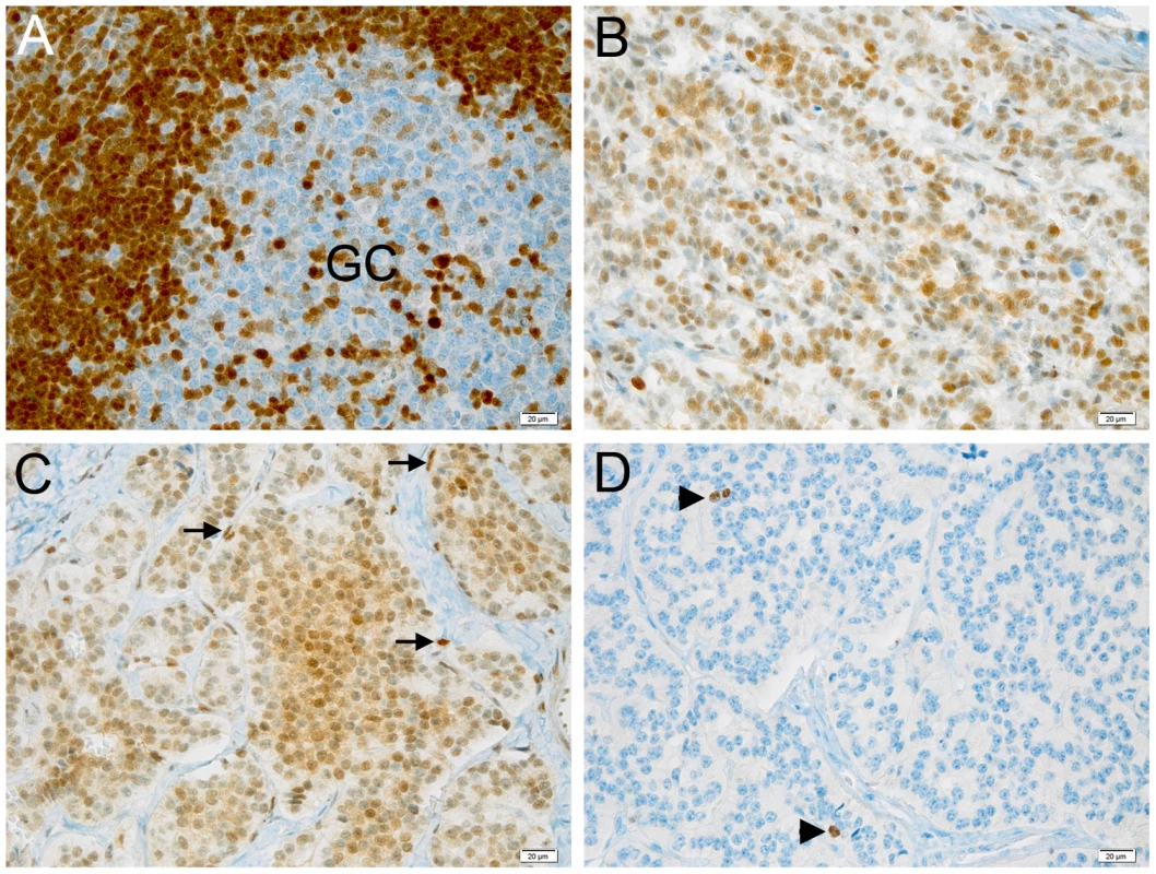 Expression of p27<sup>KIP1</sup> and Ki-67 in pancreatic tumors and control tissue.