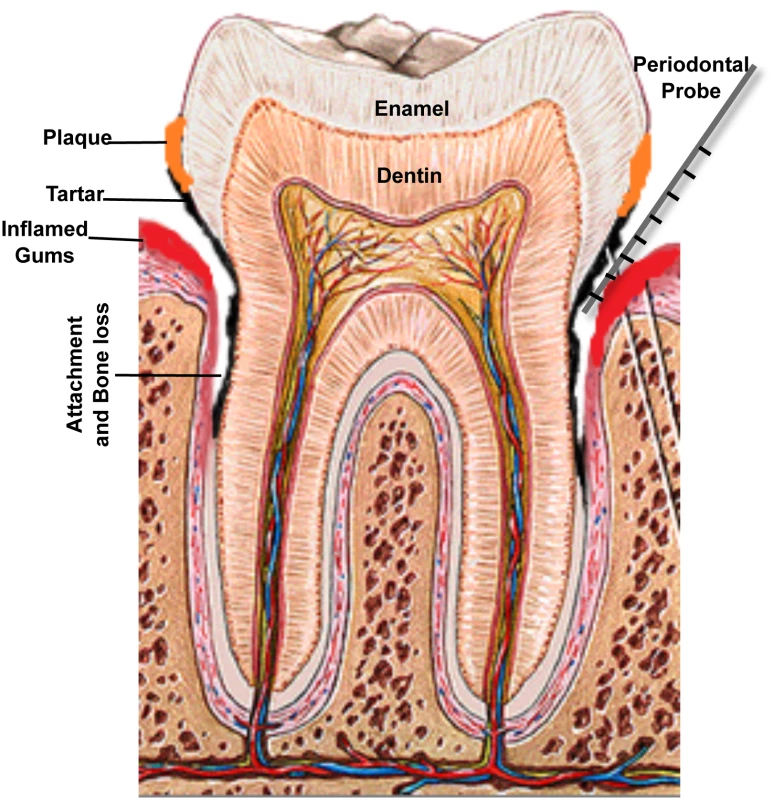 A schematic of the human tooth illustrating the process of periodontal disease development.