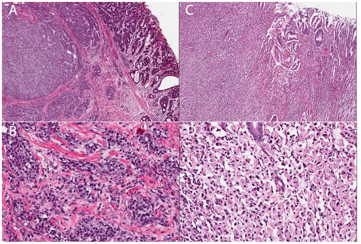 Histology of two gastric cancer patients from the Maritime Canadian family.