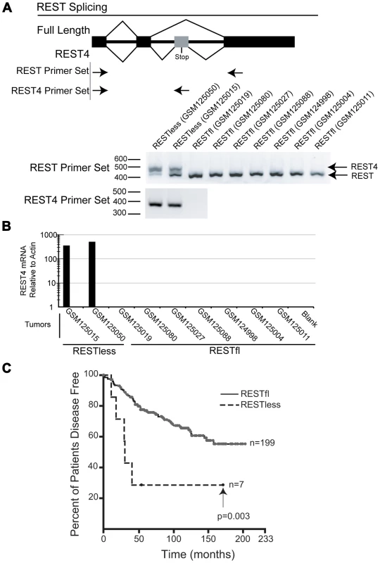 REST–less breast cancer tumors display high levels of REST4 splicing and poor prognosis.