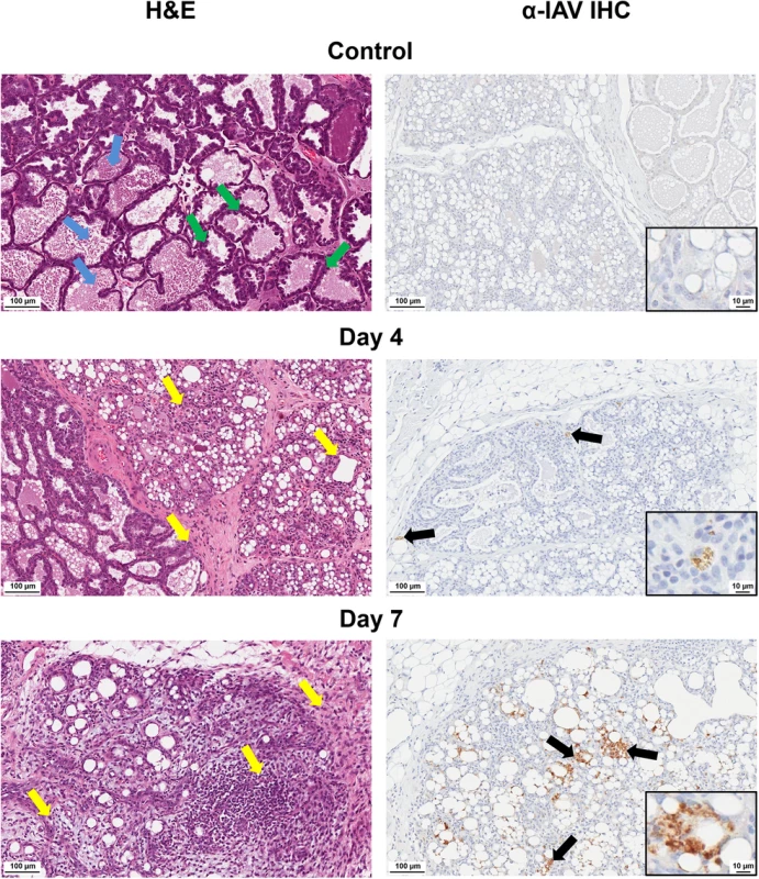 Destruction of acini and accumulation of viral protein in mammary glands of mothers of infected infants.