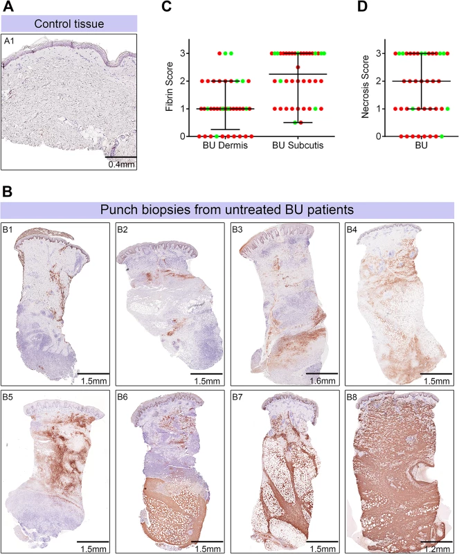Abundant fibrin deposition in the skin of patients with Buruli ulcer.