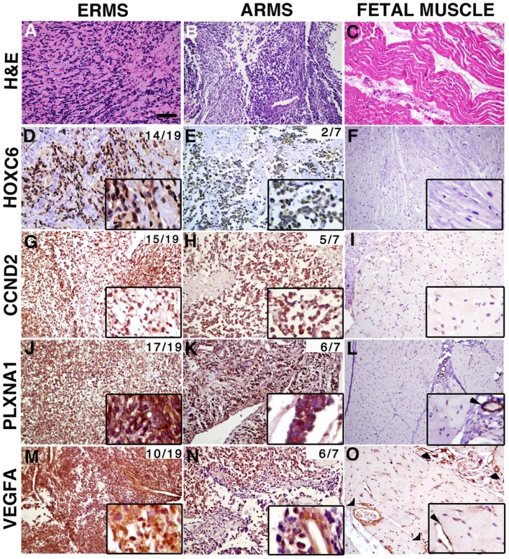 Genes contained within low copy CNAs are expressed in primary human rhabdomyosaroma but not normal fetal muscle.