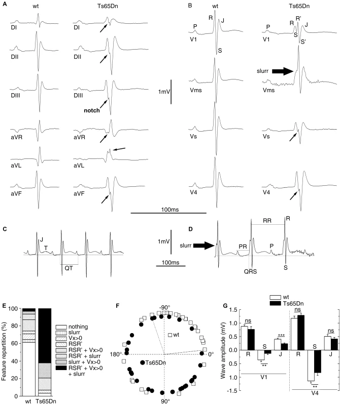 ECG analyses of urethane anaesthetized Ts65Dn adult mice revealed cardiac conduction anomalies.