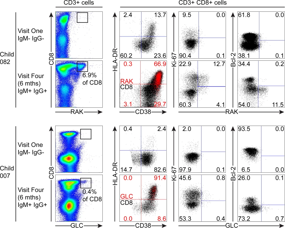 EBV-specific CD8+ T cell response and phenotype of PBMCs from children seronegative at visit one who at visit four had been very recently infected (IgM+ IgG+/-).