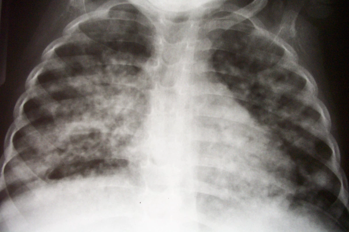 Chest Radiograph of an Infant with Pulmonary Tuberculosis, Complicated by an Immune Reconstitution Syndrome Event Following the Initiation of Antiretroviral Therapy