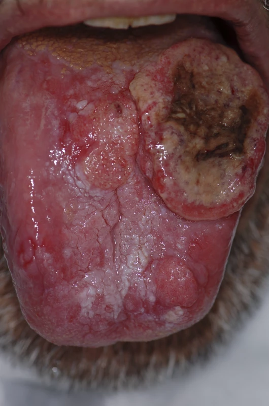 The Dorsum of the Patient's Tongue