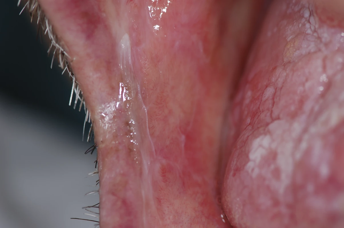 Interlacing White Striae on the Right Buccal Mucosa, Consistent with the Diagnosis of Oral Lichen Planus