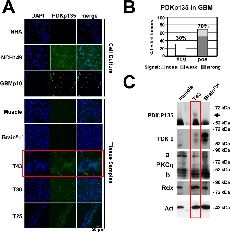 Detection of PDK1phosphoS135 in human cancer tissues.