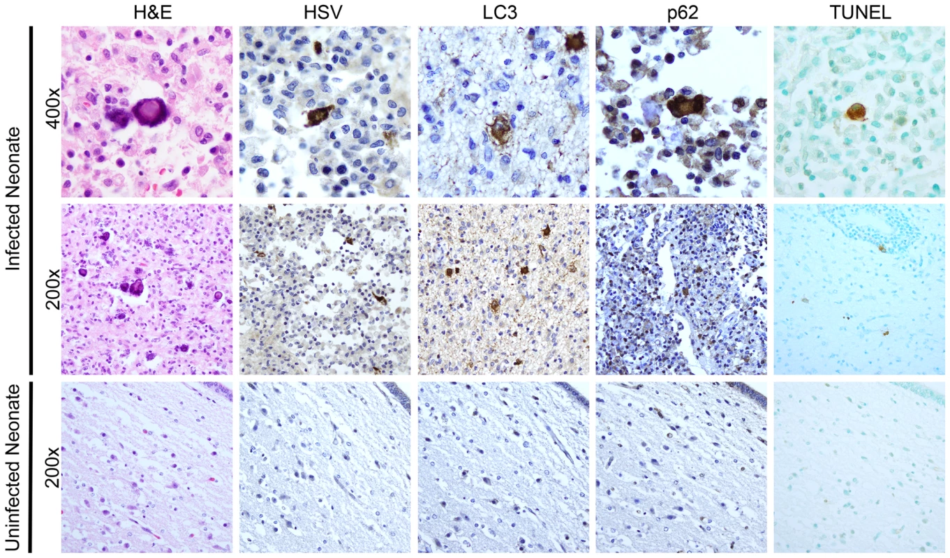 Activation of autophagy and apoptotic cell death in a human case of neonatal HSV encephalitis.