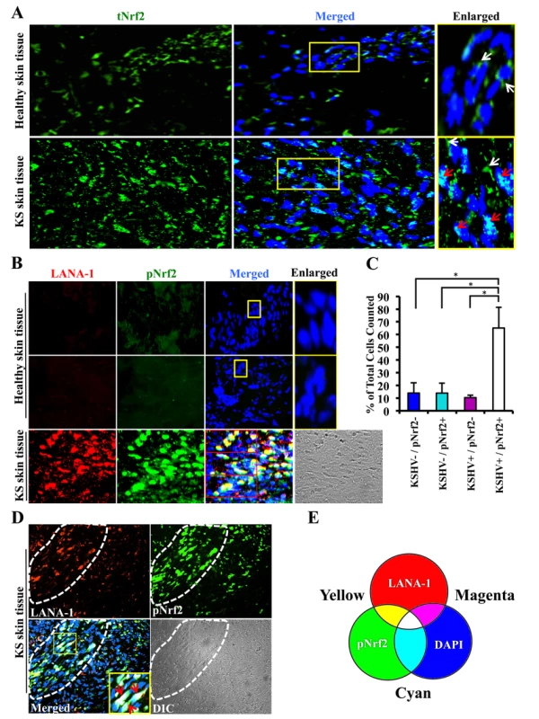 Immunofluorescence analysis of Nrf2 levels in Kaposi's sarcoma skin lesions.