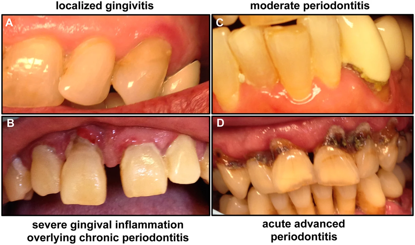 Images of patients demonstrating the clinical progression of periodontal disease from gingivitis to advanced periodontitis.