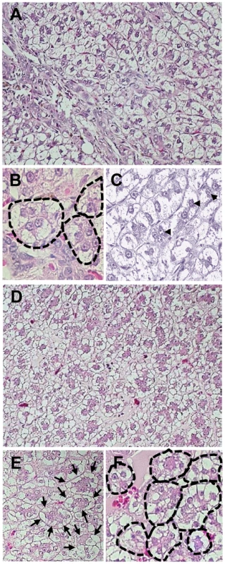 Histological characteristics of HCC in 5/M and 9/M woodchucks at 55 months post-inoculation with 100 WHV virions.