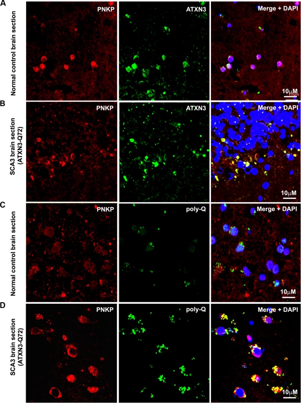 PNKP co-localizes with wild-type and mutant ATXN3 in human brain sections.