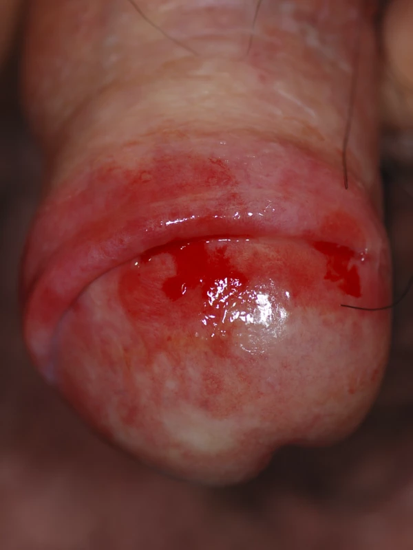 Erosive Area on the Glans Penis, Consistent with the Diagnosis of Lichen Planus