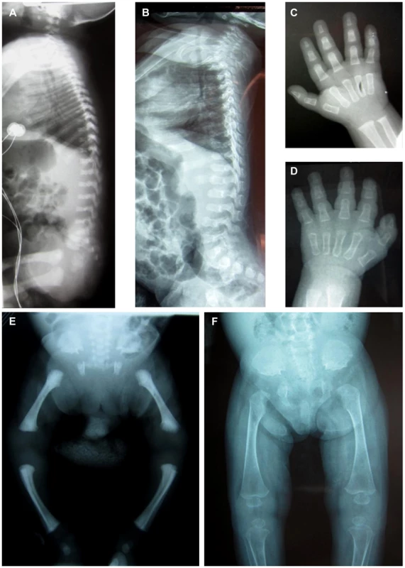 Radiological features of the patients F2-IV.3 and F1-IV.3.