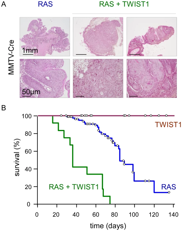 Twist1 promotes tumor progression <i>in vivo</i>.