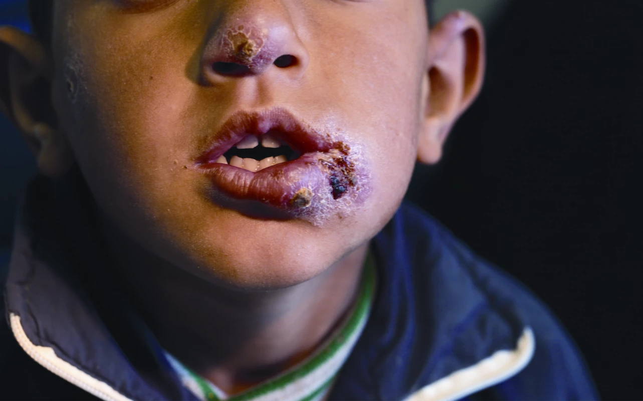 Syrian child from a Lebanon refugee camp, presenting multiple lesions from cutaneous leishmaniasis, courtesy of Dr. Ibrahim Khalifeh