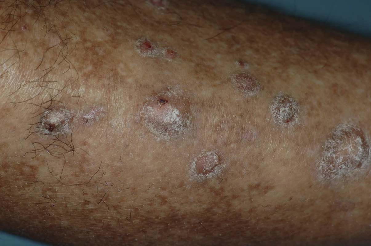 Polygonal, Flat-Topped Papules Covered with a Fine Network of White Lines on the Legs, Consistent with the Diagnosis of Lichen Planus