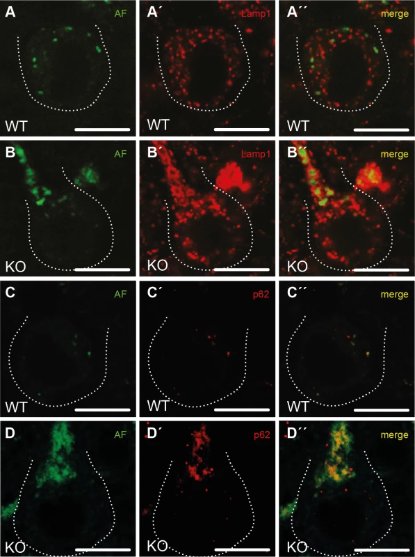 Purkinje cells in Spatacsin knockout mice accumulate abnormal autolysosomes.