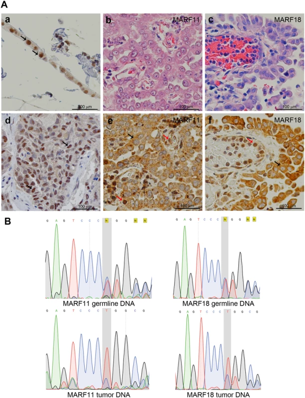 BAP1 cytoplasmic staining and LOH in MM biopsies.