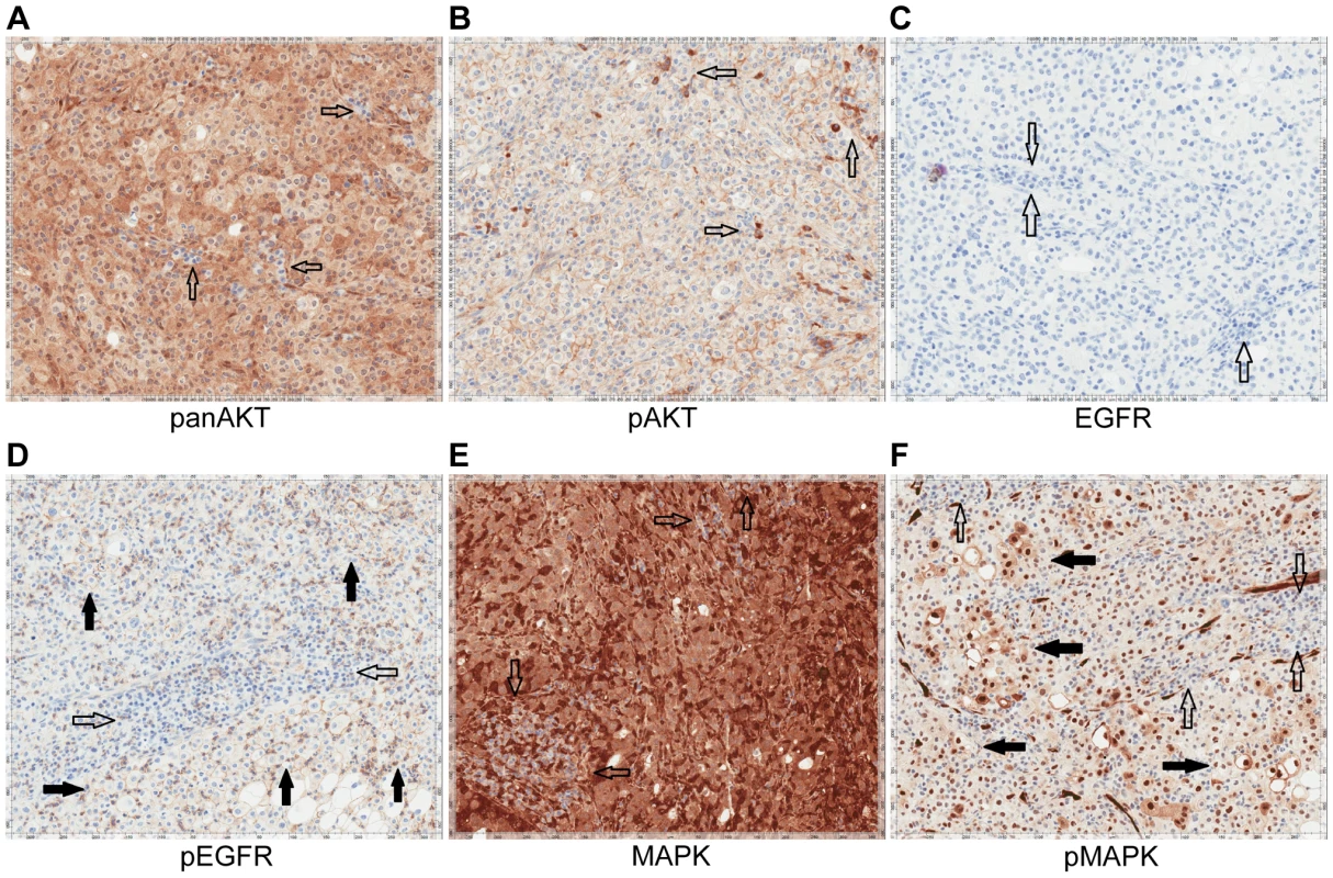 Immunohistochemistry of Patient 3's tumor demonstrating activation of the EGFR pathway.