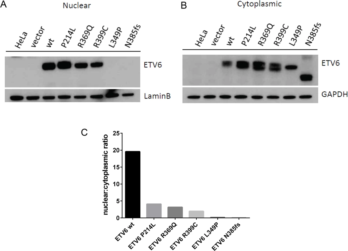 Germline <i>ETV6</i> mutations impair localization of the ETV6 protein.