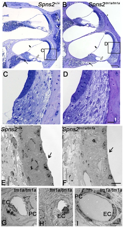 Pathological changes in stria vascularis and normal position of Reissner's membrane.