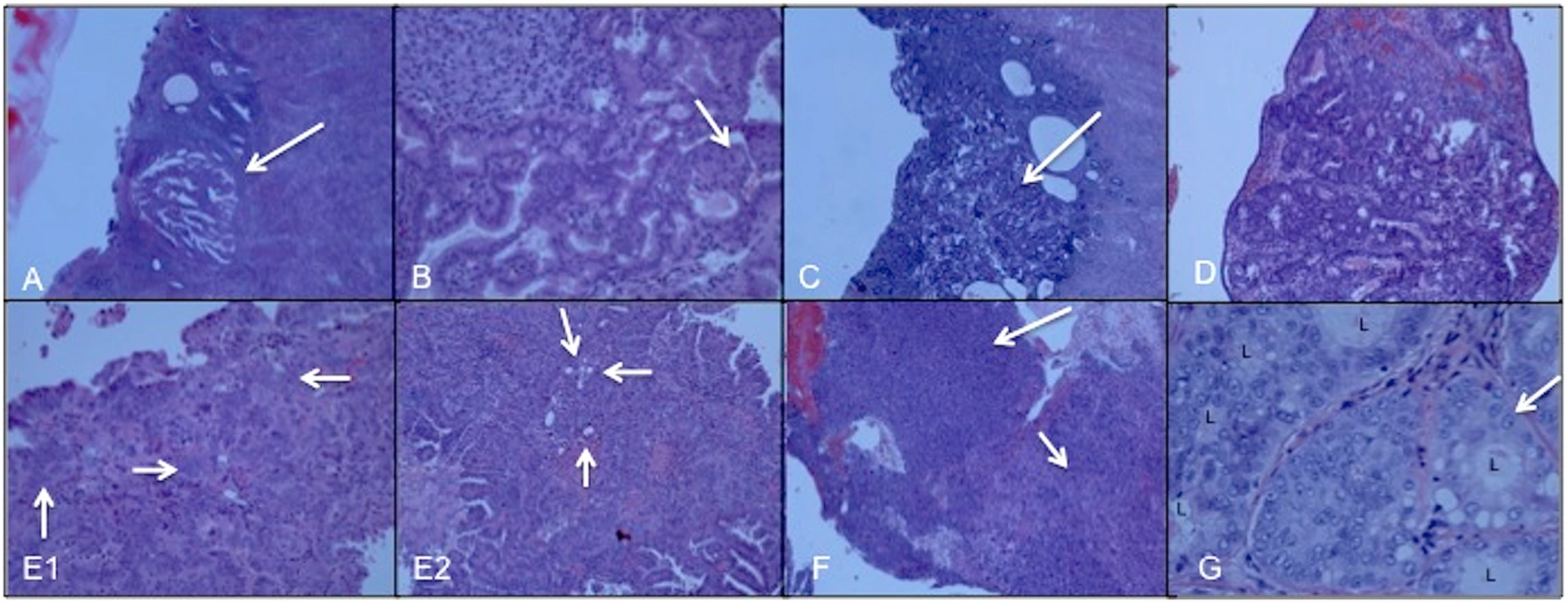 Microscopic views of hematoxylin-eosin stained sections of all seven uterine cancer specimens diagnosed by classic histopathology.