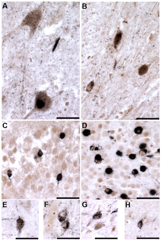 Tau tubulin kinases are co-expressed with phospho-TDP-43 pathology in ALS cases.