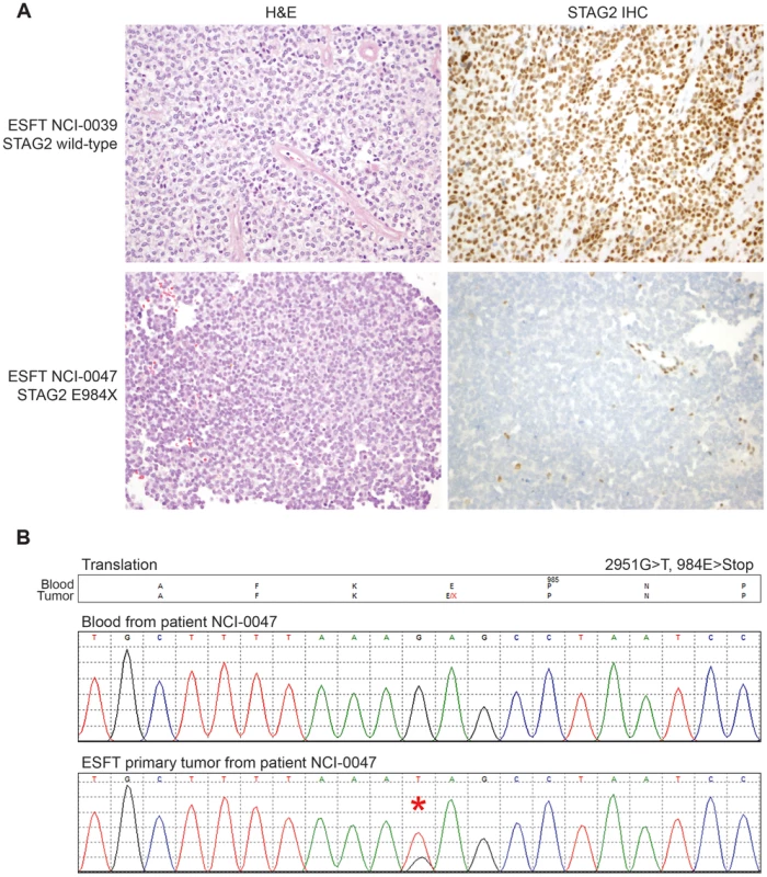 Examples of immunohistochemistry showing STAG2 expression in Ewing sarcoma tumor samples.
