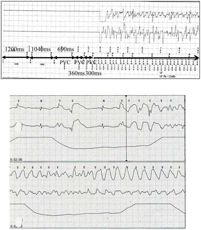 Ventricular fibrillation in patients with <i>SEMA3A</i><sup>I334V</sup>.