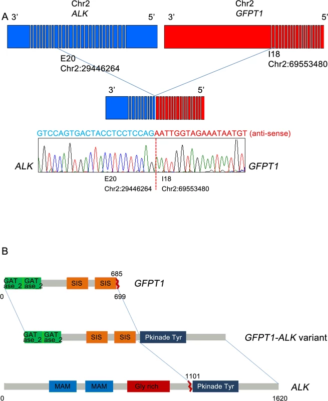 Gene fusion between <i>GFPT1</i> and <i>ALK</i>.