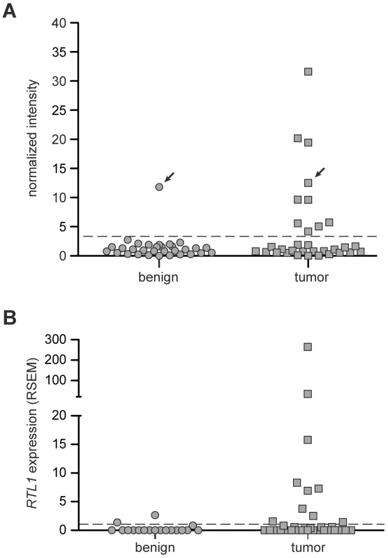 Expression of <i>RTL1</i> in human HCC.