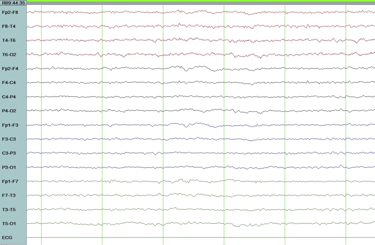 Electroencephalogram after Combination Anti-Epileptic Therapy with the Focal Spikes Abolished