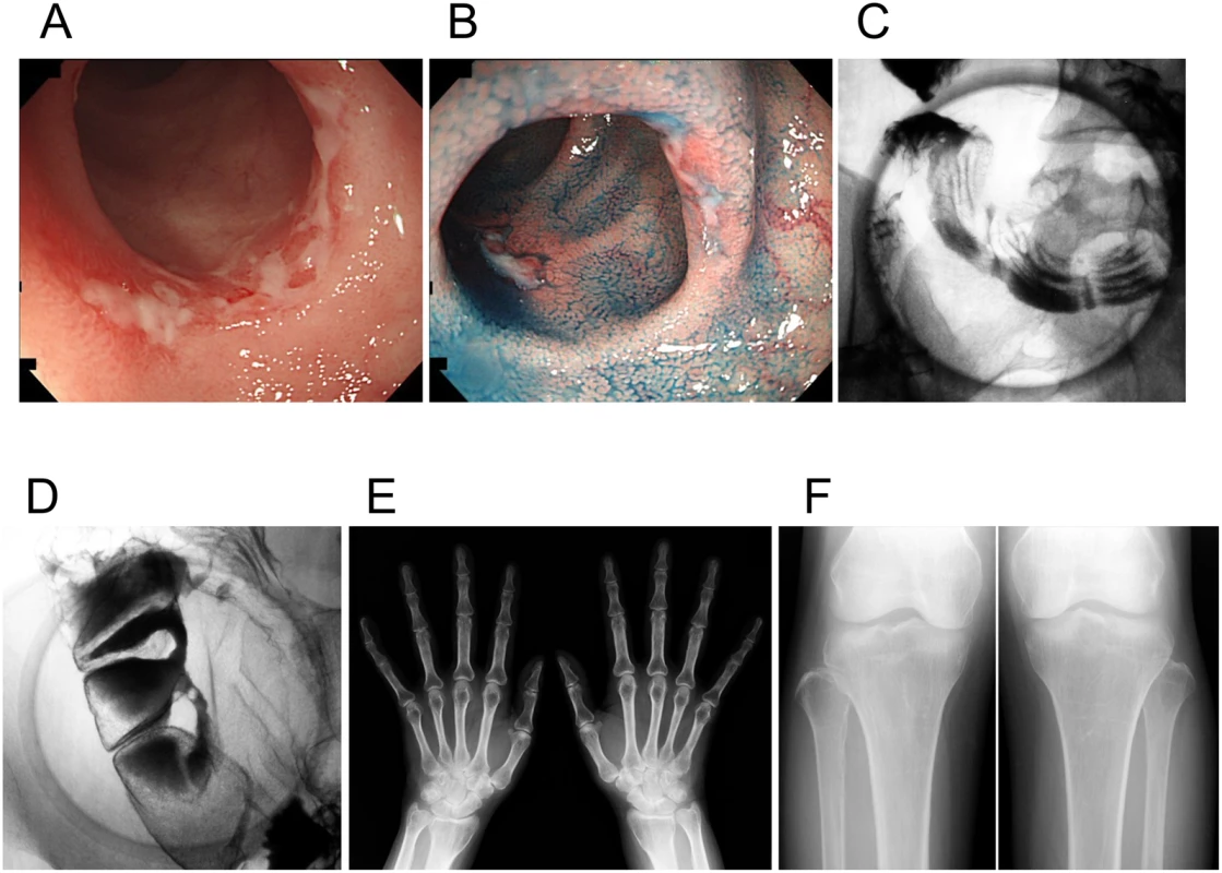 Clinical images of an individual with chronic nonspecific multiple ulcers of the small intestine (patient A-V–2).