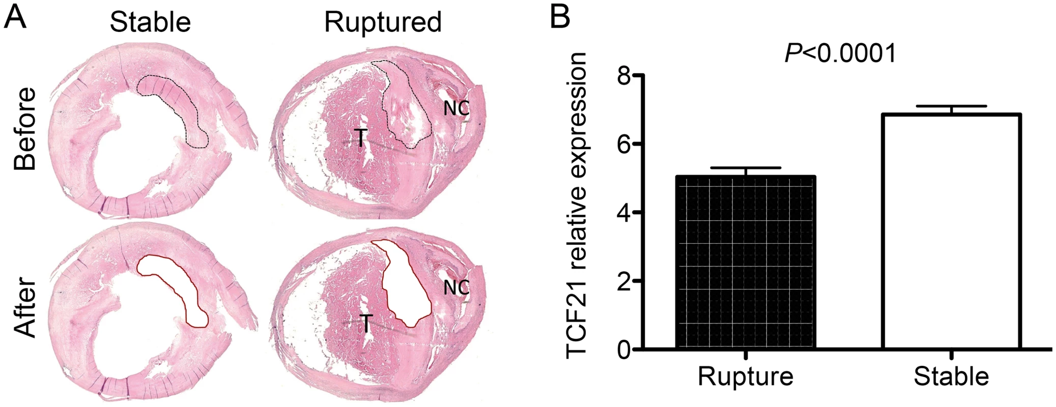 Differential <i>TCF21</i> gene expression in fibrous cap of stable vs. ruptured atherosclerotic plaque.
