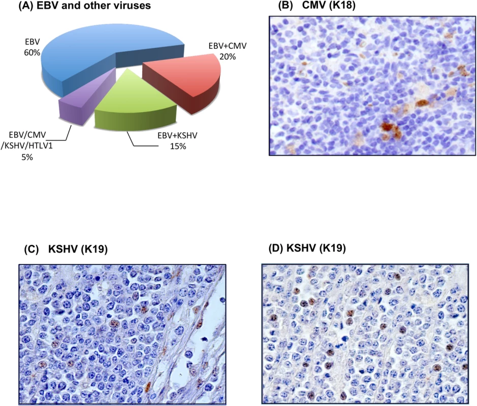 (A) RNA-Seq technology reveals the presence of EBV and of other viruses. In particular, 5/20 cases contain human herpesvirus 5 (CMV), 4/20 human herpesvirus 8 (KSHV), and 1/20 human T-lymphotropic virus 1 (HTLV-1). (B) Immunohistochemical evaluation demonstrates the presence of CMV in the stromal cells in the adjacent reactive lymphoid tissue. CMV stain, Original Magnification (O.M.): 40x. (C) KSHV positivity is shown, respectively in few neoplastic cells and in the endothelial cells within the neoplastic proliferation. LANA-1 (LN53 antibody), O.M.: 40x; (D) LANA-1 (AT4C11 antibody) O.M.: 40x.