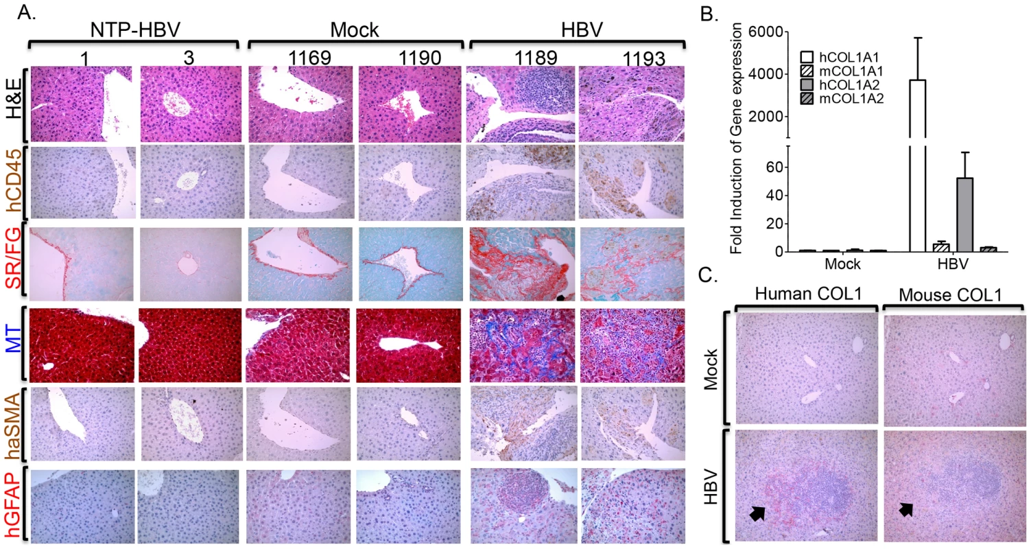 HBV infection induces chronic hepatitis and human liver fibrosis.