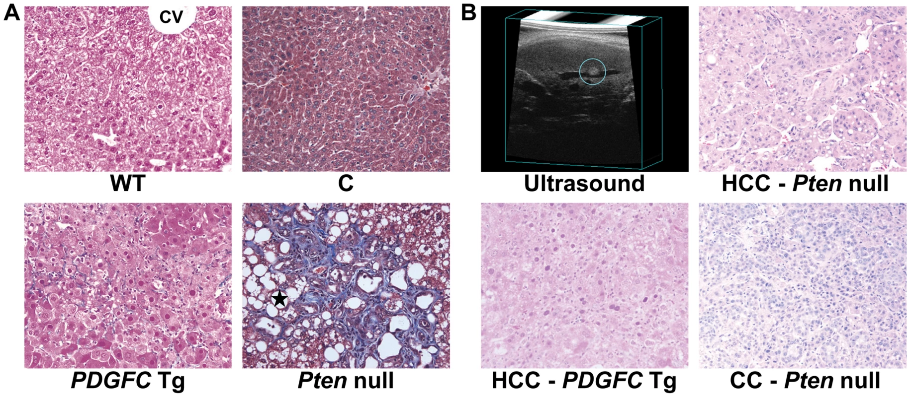Collagen deposition and tumor morphology in <i>PDGFC</i> Tg and <i>Pten</i> null liver.