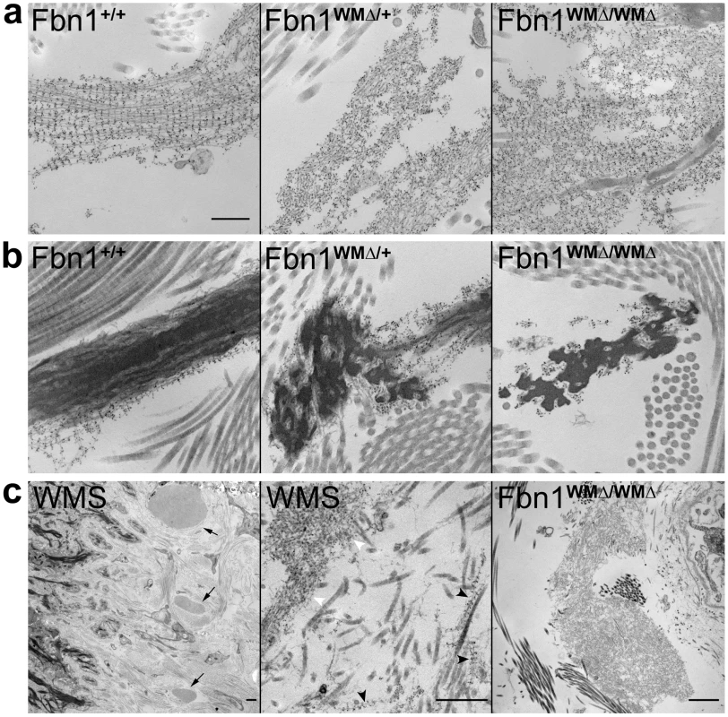 Ultrastructural abnormalities in microfibrils in WMΔ mouse and WMS human skin.