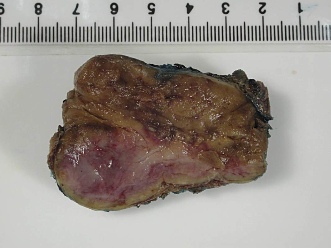 Macroscopic Appearance of the Resected Para-Aortic Mass