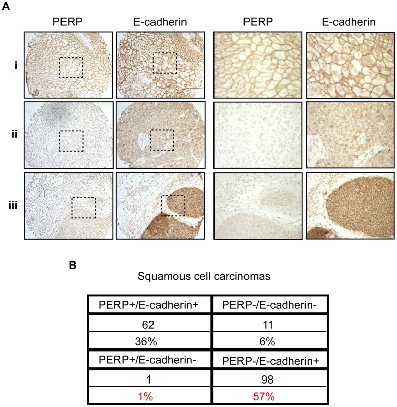 PERP loss with E-cadherin maintenance is a common event in human skin SCCs.