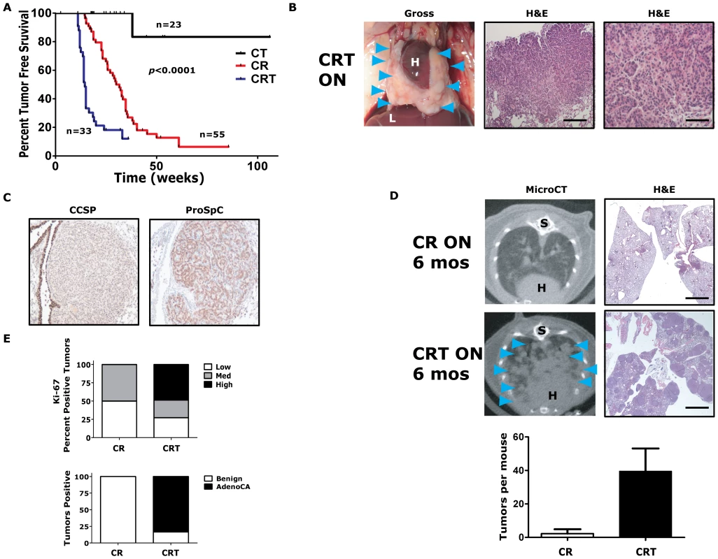 <i>Twist1</i> accelerates <i>Kras<sup>G12D</sup></i>-induced lung tumorigenesis and promotes progression to adenocarcinoma.