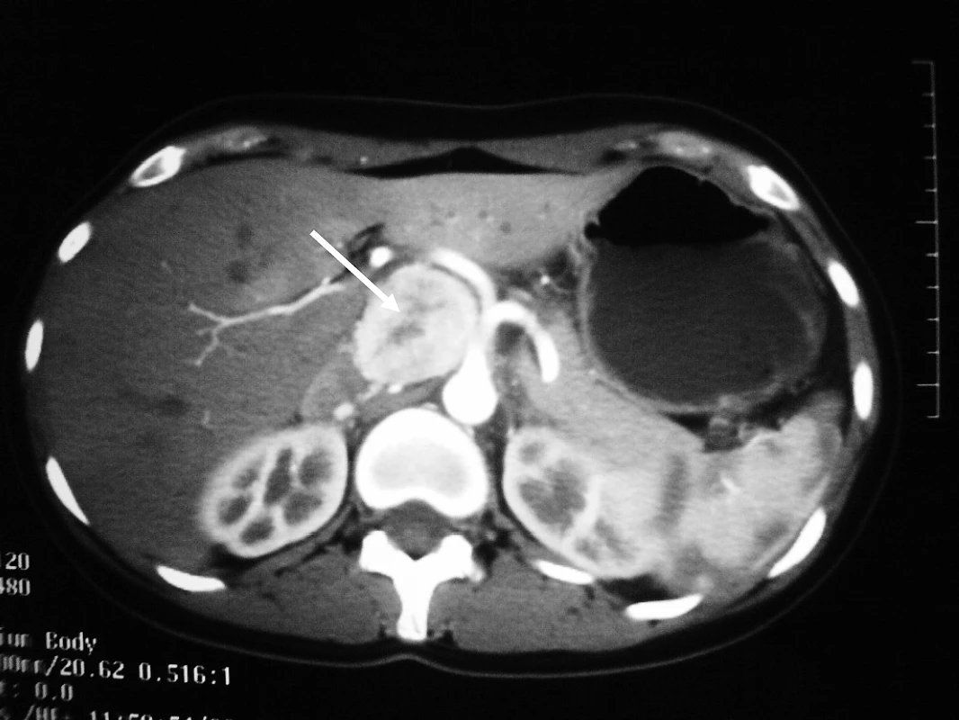 Computer Tomography Revealing an Extra-Adrenal Paraganglioma in the Celiac Region, Measuring 4.5 cm in Diameter