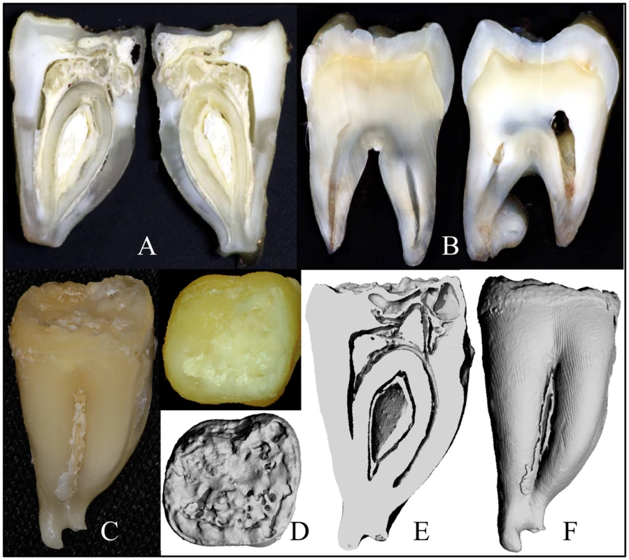 Images of <i>FAM20A</i><sup>−/−</sup> tooth #18.